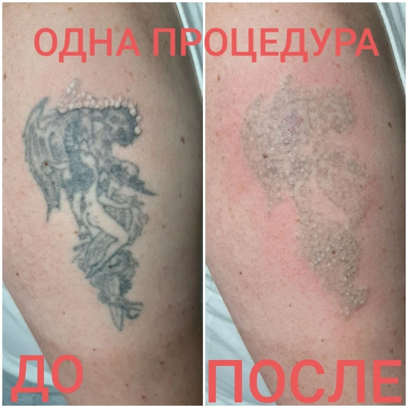 Удаление лазером. 