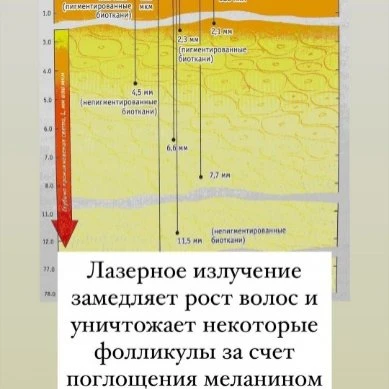 Лазерная эпиляция и электроэпиляция. Плюсы и минусы.