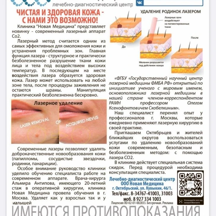 Удаление папиллом