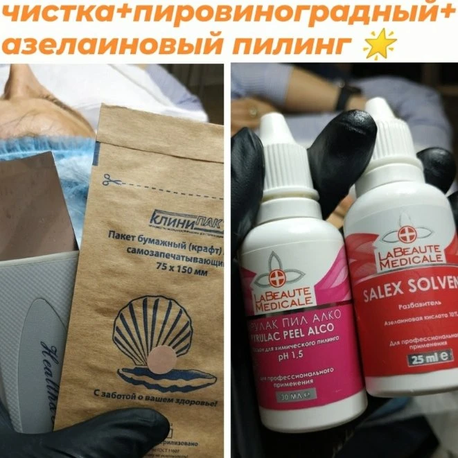 Комбинированная чистка+пировиноградный+азелаиновый пилинг для проблемной кожи 👍