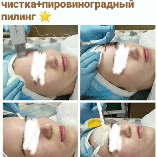 Комбинированная чистка+пировиноградный пилинг 🌸