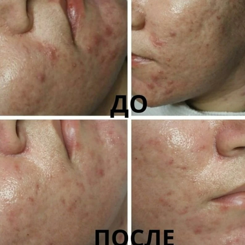 Коррекция угревой болезни 🌺