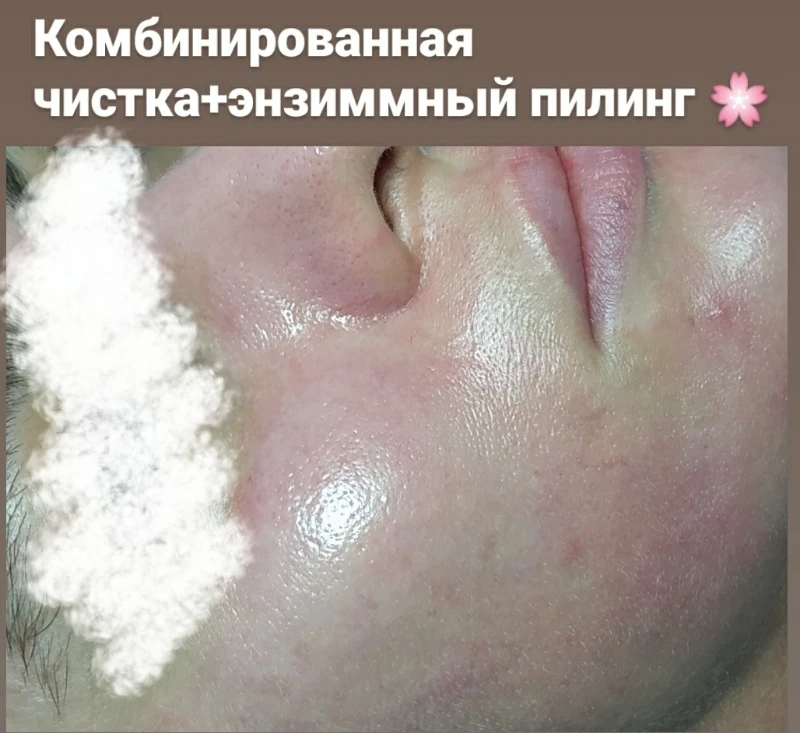 Комбинированная чистка+Энзимный пилинг 🌹