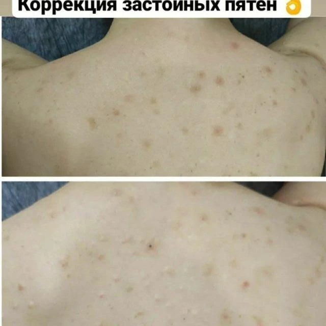 Коррекция застойных пятен и травматической пигментации 👌