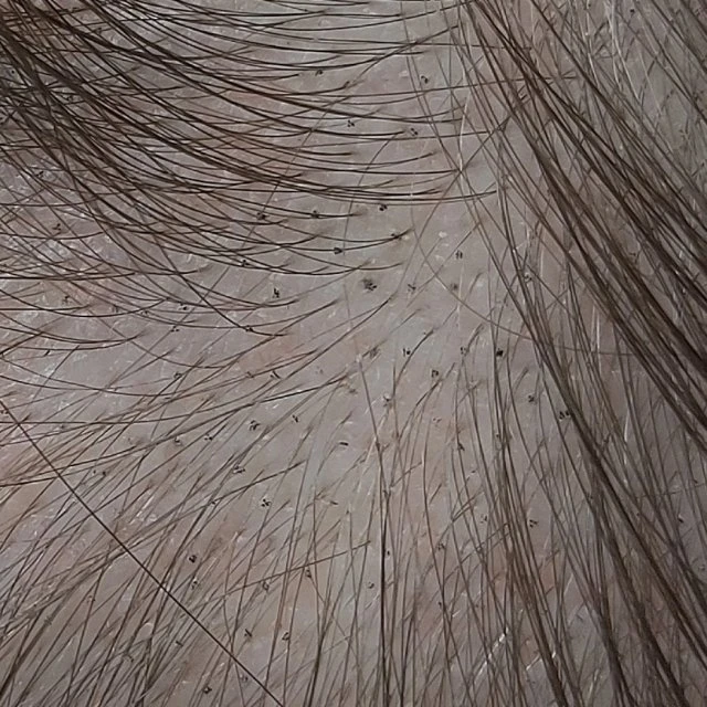 Что такое трихопигментация? 