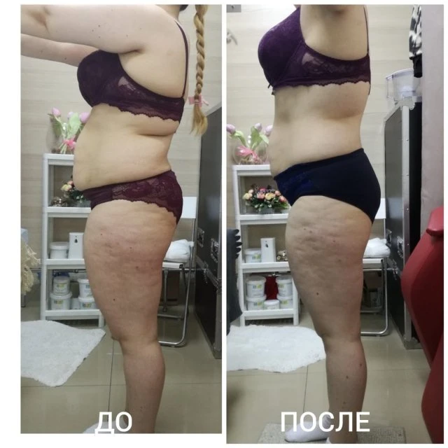 LPG массаж Сочи