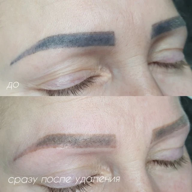 Удаление татуажа Сочи