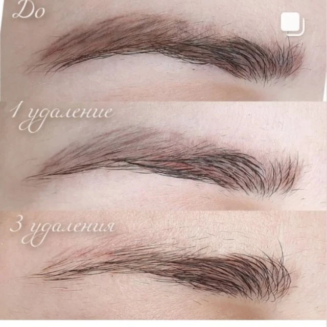 Лазерное удаление микроблейдинга