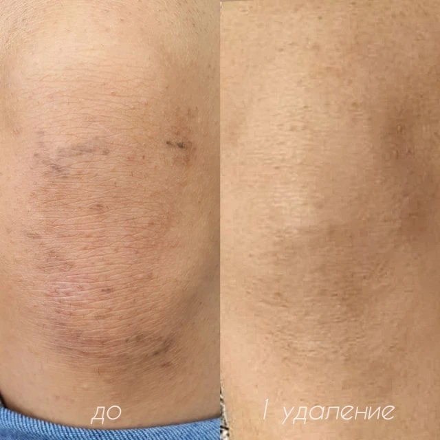 Удаление инородных частиц под кожей Сочи