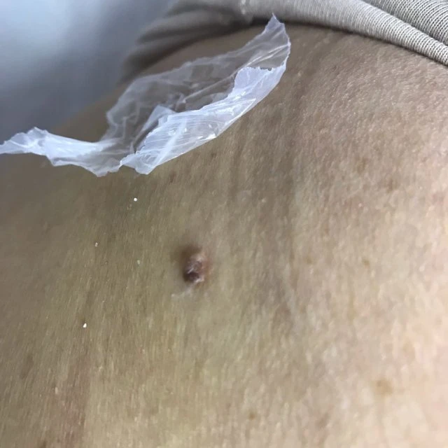🍀🌿☘️🌱Удаление пигментных пятен, папиллом, веснушек , выпуклостей на коже, небольших рубцовых изменений. Быстро, безболезненно и безопасно для вашего здоровья