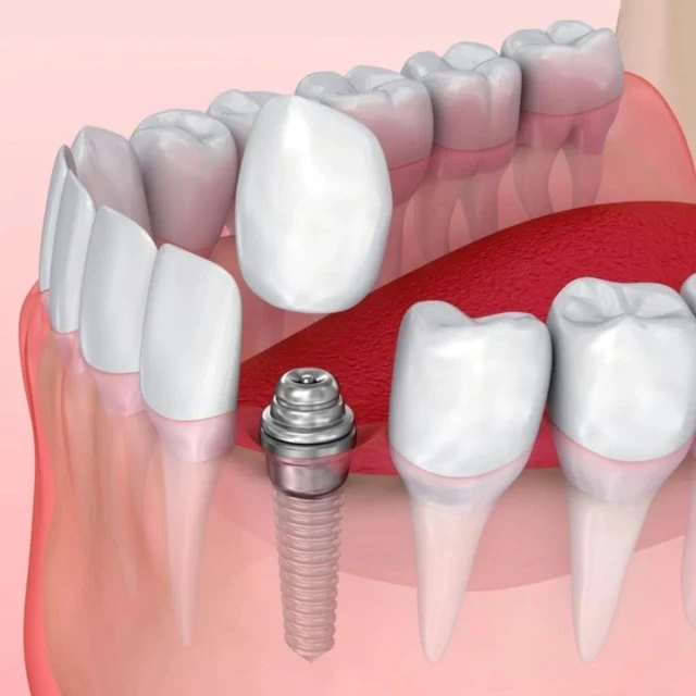 Имплантация зубов в клинике Dental White/Дентал Вайт 