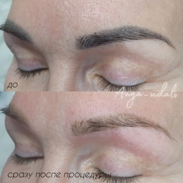 Лазерное удаление татуажа Сочи