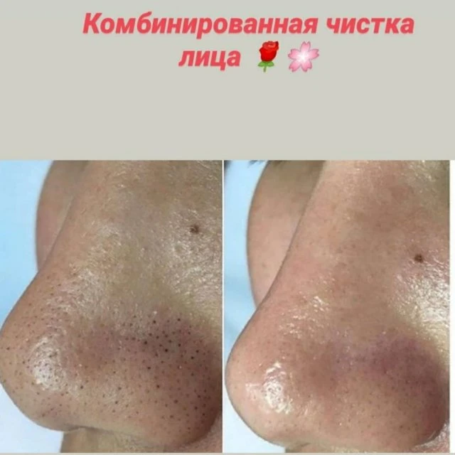 Комбинированная чистка лица 👌