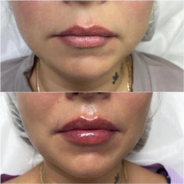 Контурная пластика губ 💉👄