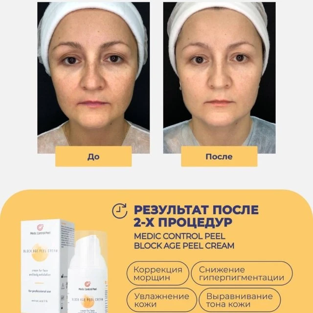 Пилинг
